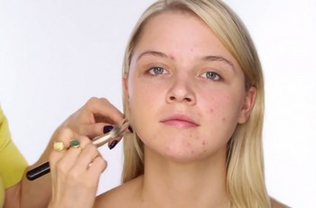 bouttton-acne